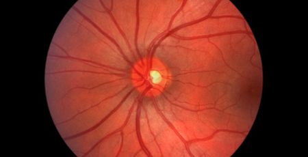 Makuladegeneration Antioxidantien Sehen Netzhaut Augenoptiker